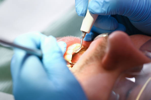 Best Emergency Dentist for Lost Fillings or Crowns in Pueblo West, CO