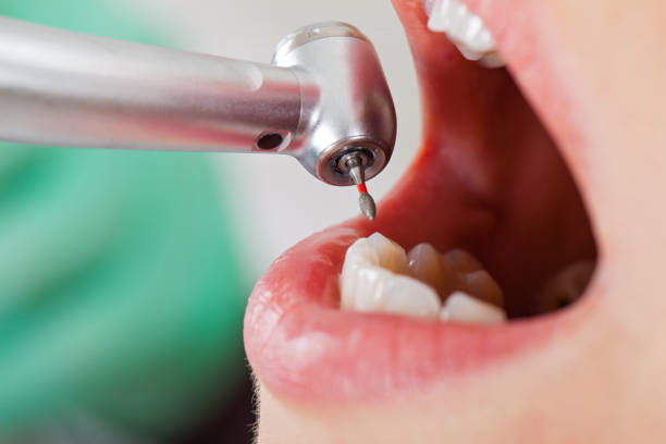 Best Emergency Dental Extractions in Pueblo West, CO